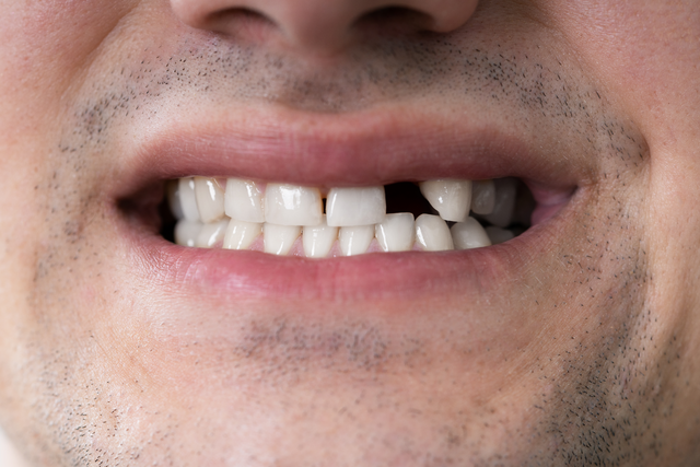 dental implants near you