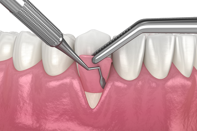 bone grafting and soft tissue grafting near you