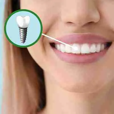 dental implants pyarmid dental