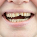 chipped tooth repair in coquitlam when to call a dentist right away