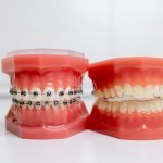 braces-vs-invisalign-in-fort-mcmurray-which-is-right-for-you
