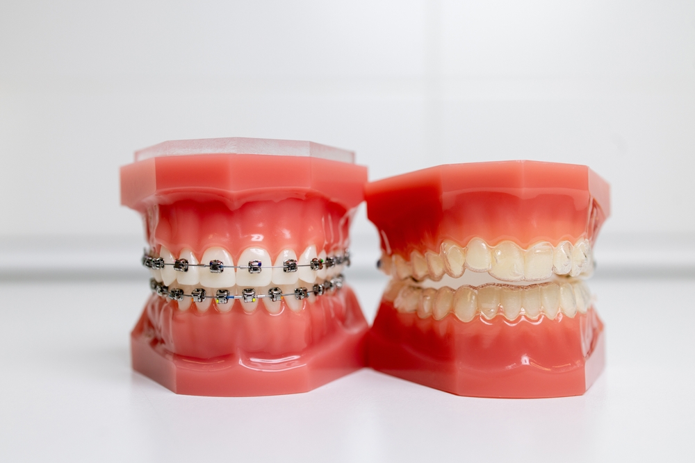 braces-vs-invisalign-in-fort-mcmurray-which-is-right-for-you