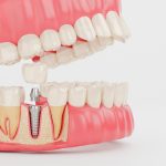 why do dentists recommend bone grafting before a dental implant