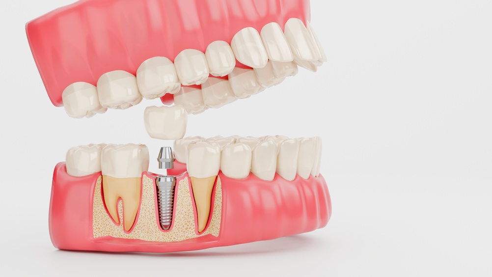 why do dentists recommend bone grafting before a dental implant